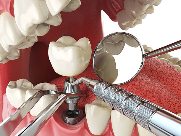Best Emergency Dentist for Knocked-Out Tooth in Ava, MO
